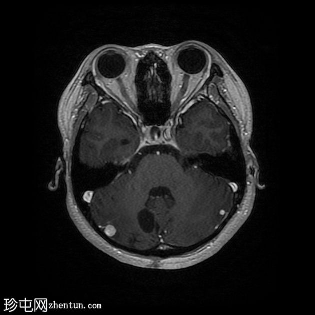 Von Hippel-Lindau 综合征