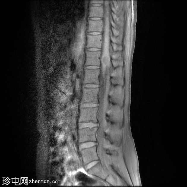 Von Hippel-Lindau 综合征