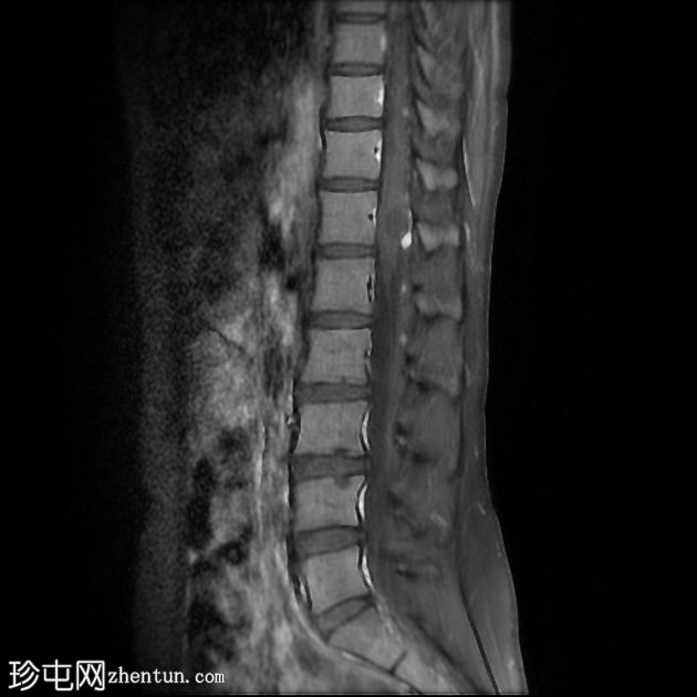 Von Hippel-Lindau 综合征