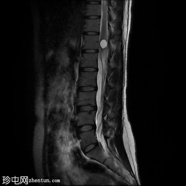 Von Hippel-Lindau 综合征