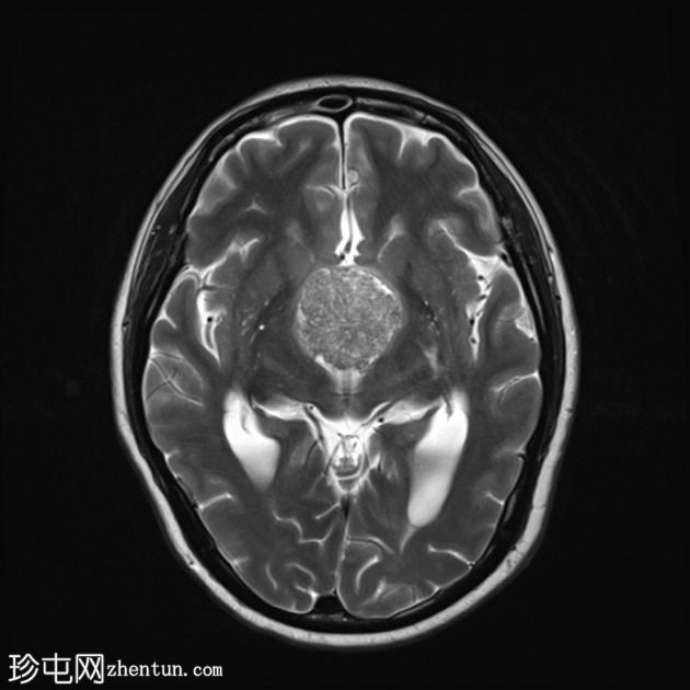 乳头状颅咽管瘤-第三脑室