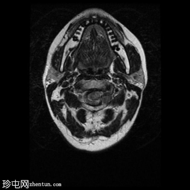 色素性神经鞘瘤（melanotic schwannoma）