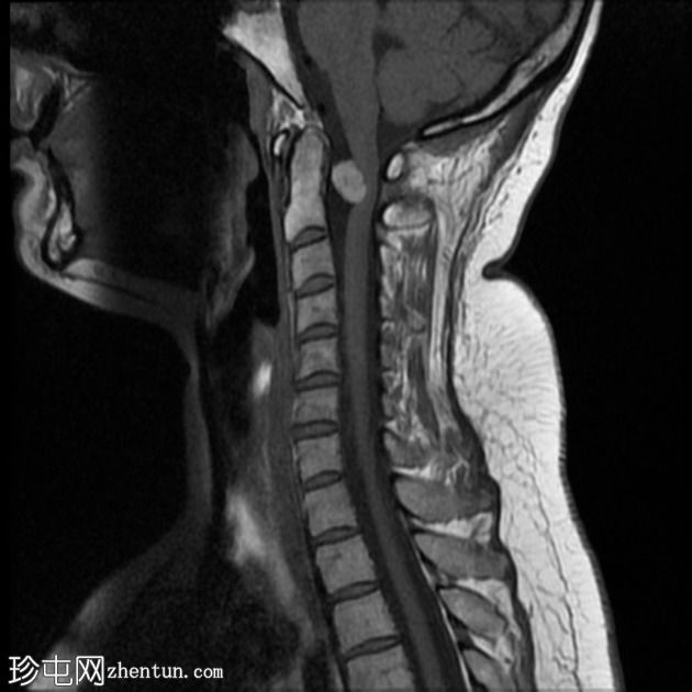 色素性神经鞘瘤（melanotic schwannoma）