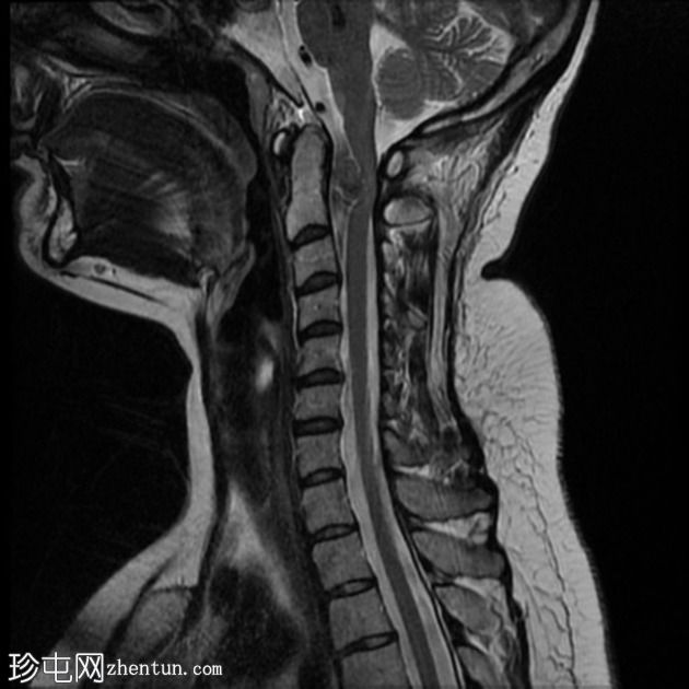 色素性神经鞘瘤（melanotic schwannoma）