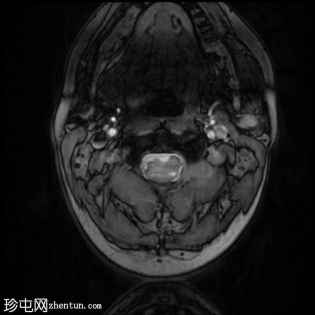 色素性神经鞘瘤（melanotic schwannoma）