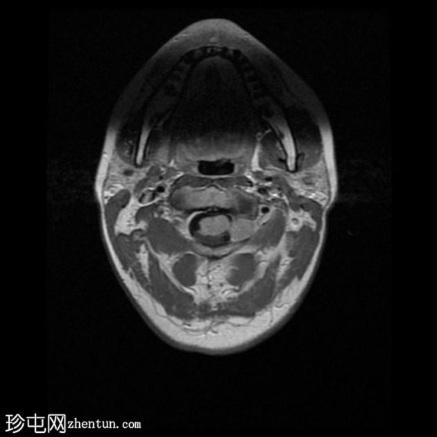 色素性神经鞘瘤（melanotic schwannoma）