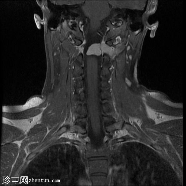 色素性神经鞘瘤（melanotic schwannoma）