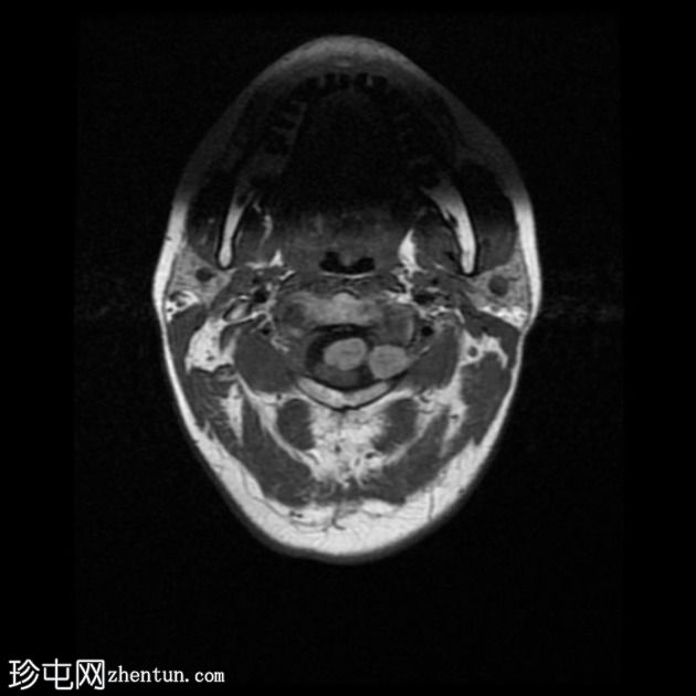 色素性神经鞘瘤（melanotic schwannoma）