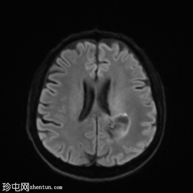 假性反应性胶质母细胞瘤(贝伐单抗)