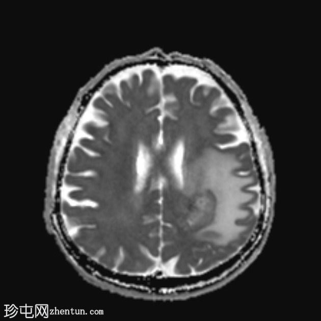 假性反应性胶质母细胞瘤(贝伐单抗)