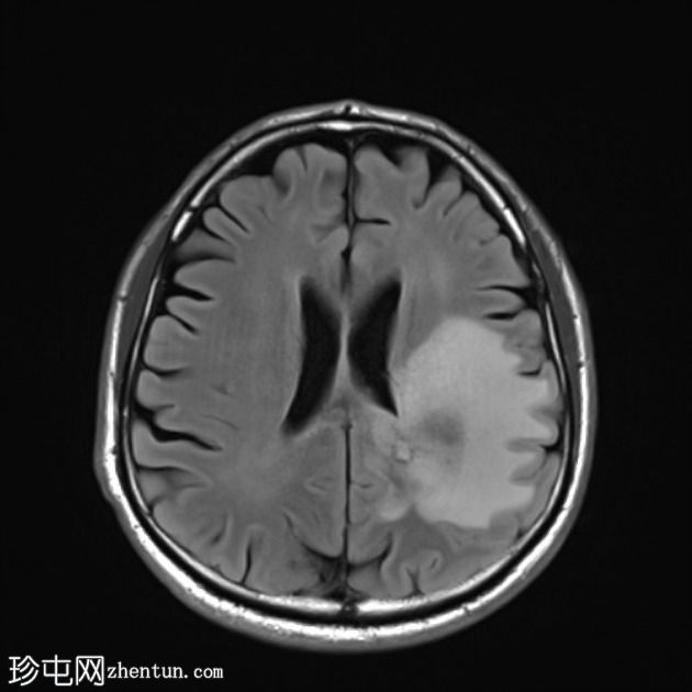 假性反应性胶质母细胞瘤(贝伐单抗)