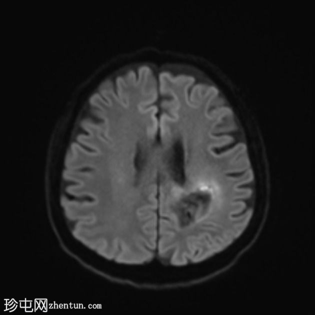 假性反应性胶质母细胞瘤(贝伐单抗)