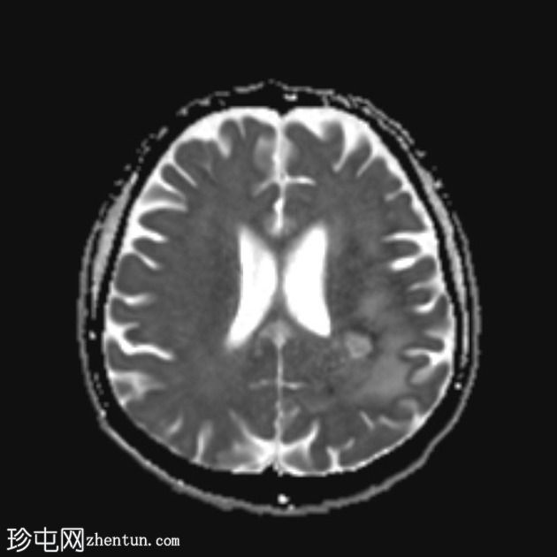 假性反应性胶质母细胞瘤(贝伐单抗)