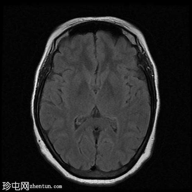 垂体大腺瘤伴中风