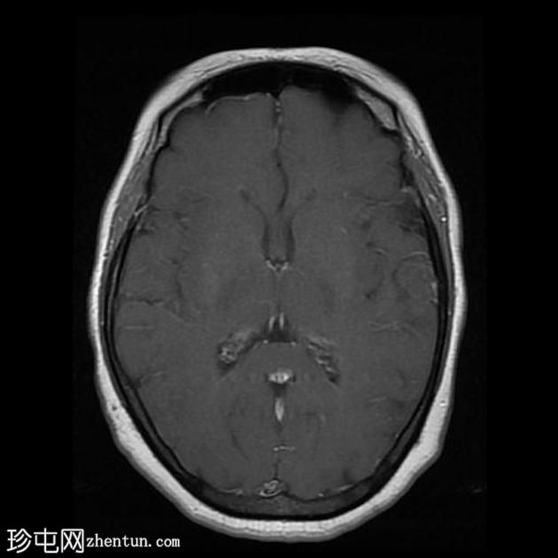 垂体大腺瘤伴中风