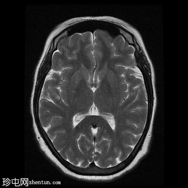 垂体大腺瘤伴中风