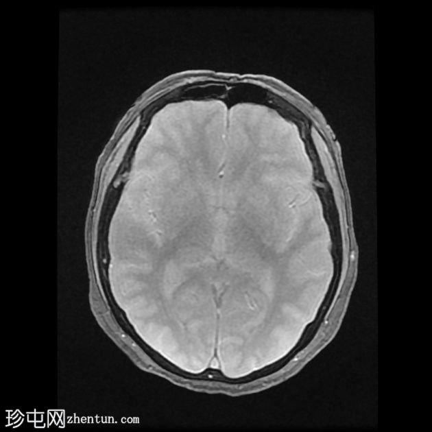 DWI/FLAIR 不匹配的额顶分水岭梗塞