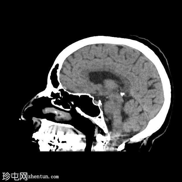 DWI/FLAIR 不匹配的额顶分水岭梗塞