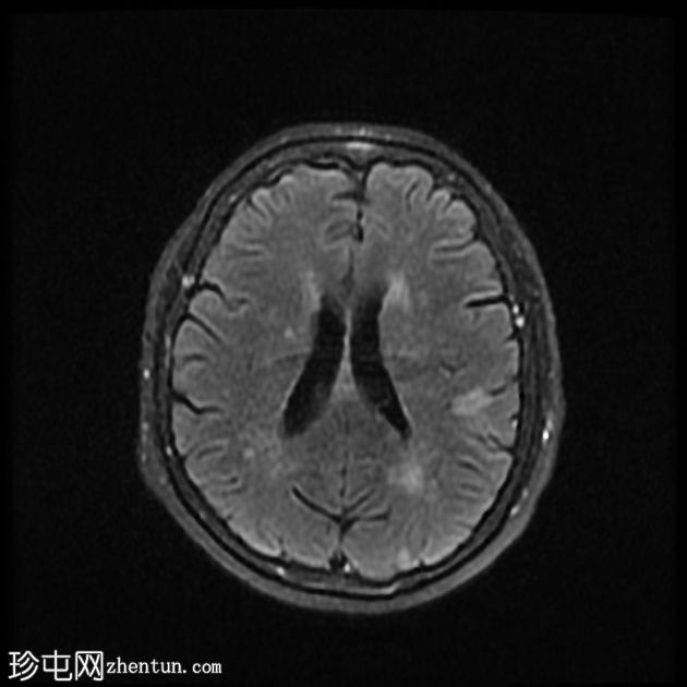 DWI/FLAIR 不匹配的额顶分水岭梗塞