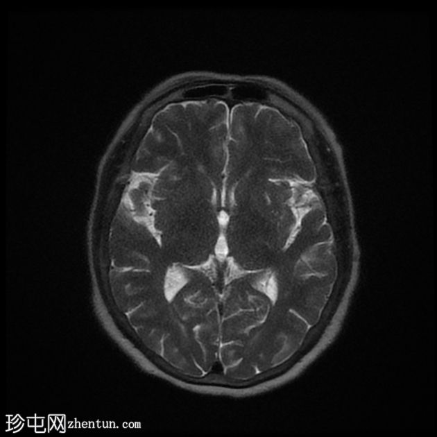 DWI/FLAIR 不匹配的额顶分水岭梗塞