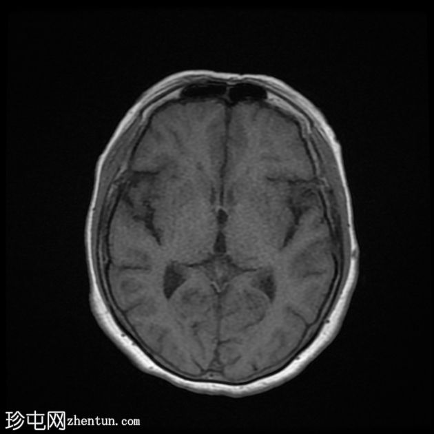 DWI/FLAIR 不匹配的额顶分水岭梗塞