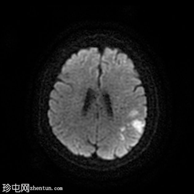 DWI/FLAIR 不匹配的额顶分水岭梗塞