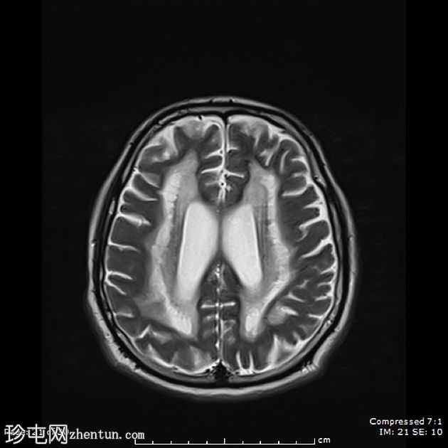 成人发病消失性白质病