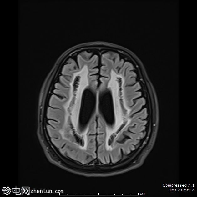 成人发病消失性白质病