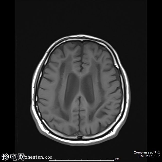 成人发病消失性白质病