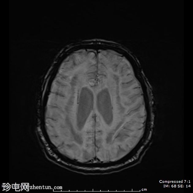 成人发病消失性白质病