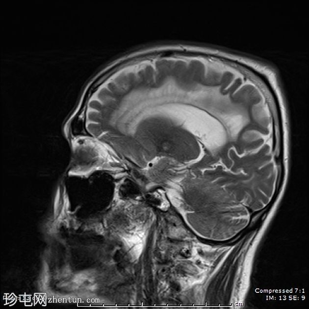 成人发病消失性白质病