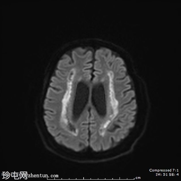 成人发病消失性白质病