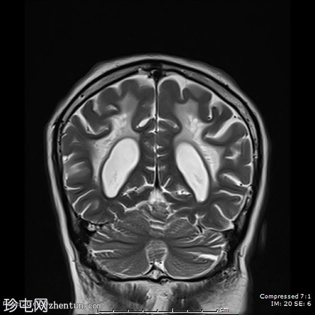 成人发病消失性白质病