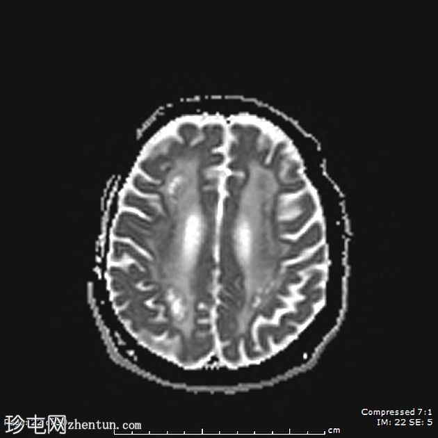 成人发病消失性白质病