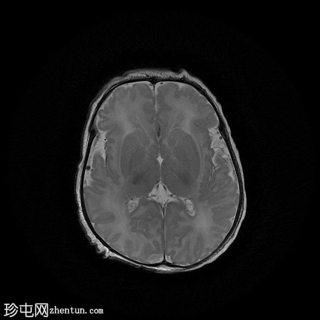 双侧裂周多小脑回