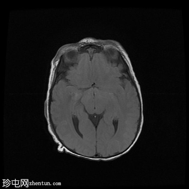 双侧裂周多小脑回