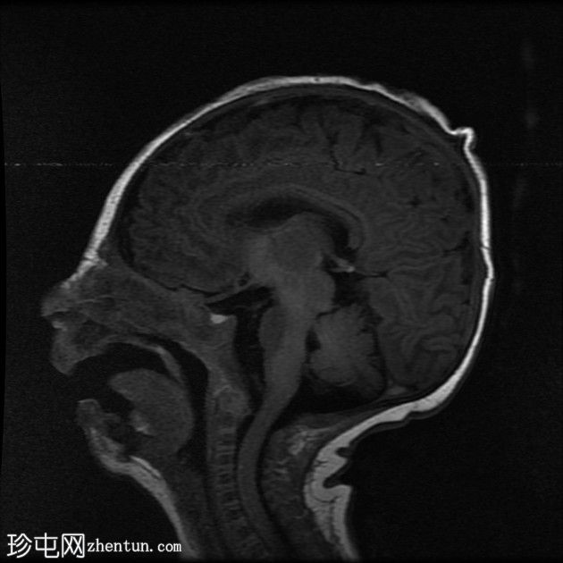 双侧裂周多小脑回