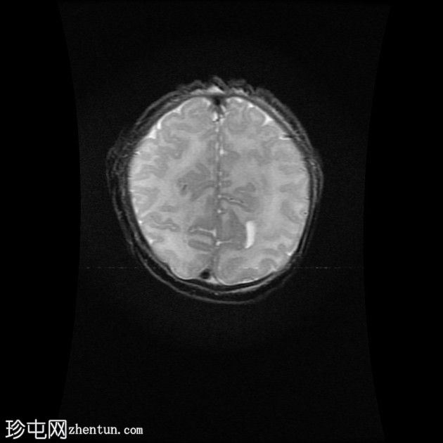 双侧裂周多小脑回