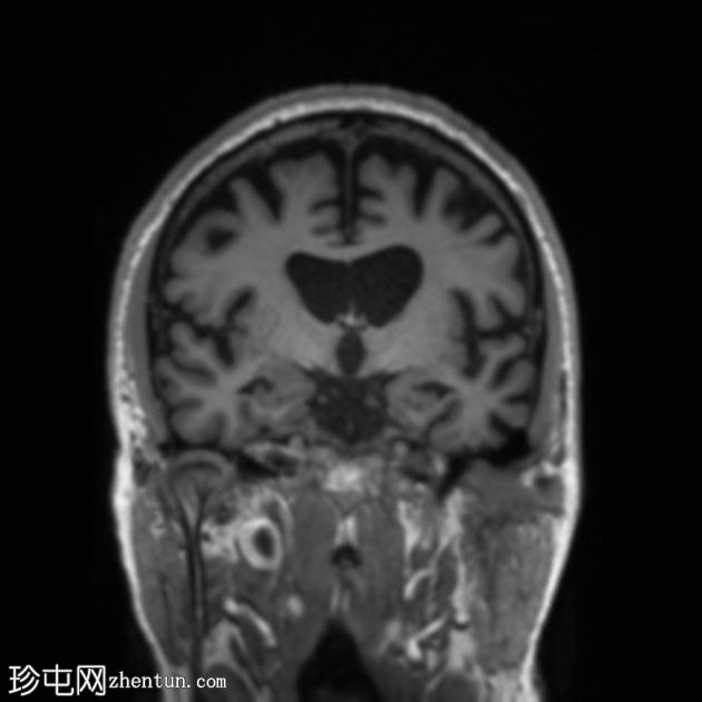 额颞叶痴呆 - 行为变异