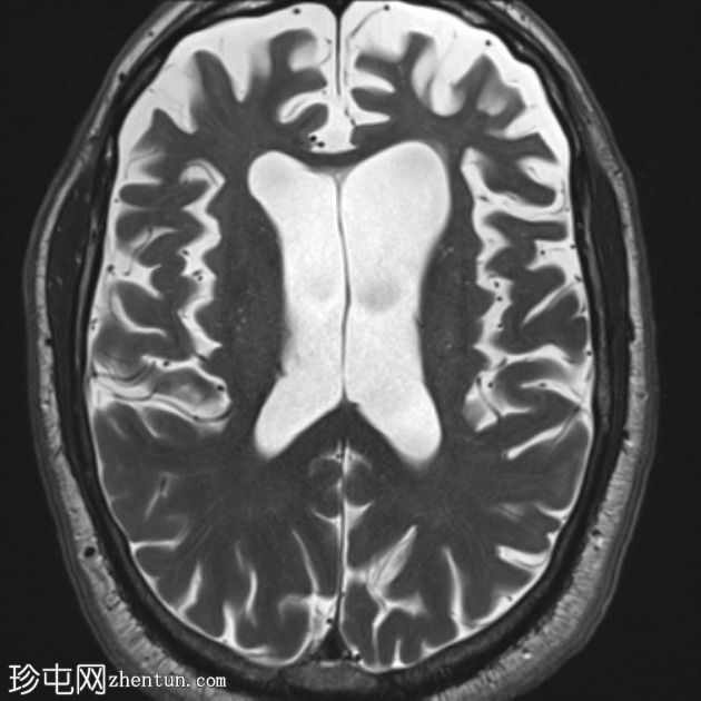 额颞叶痴呆 - 行为变异