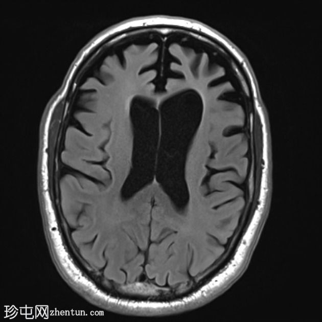 额颞叶痴呆 - 行为变异