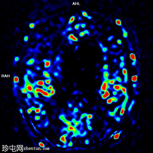 额颞叶痴呆 - 行为变异