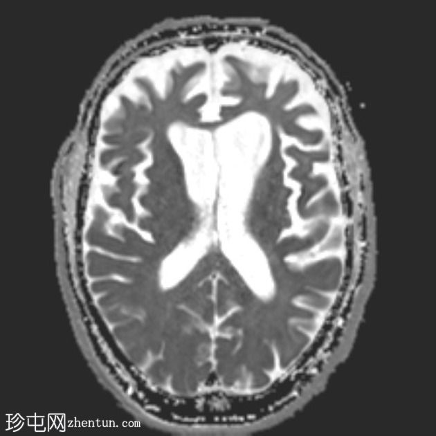 额颞叶痴呆 - 行为变异