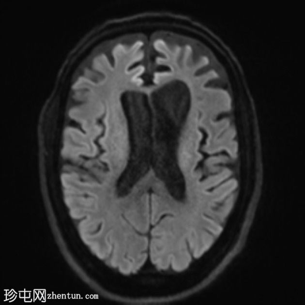 额颞叶痴呆 - 行为变异