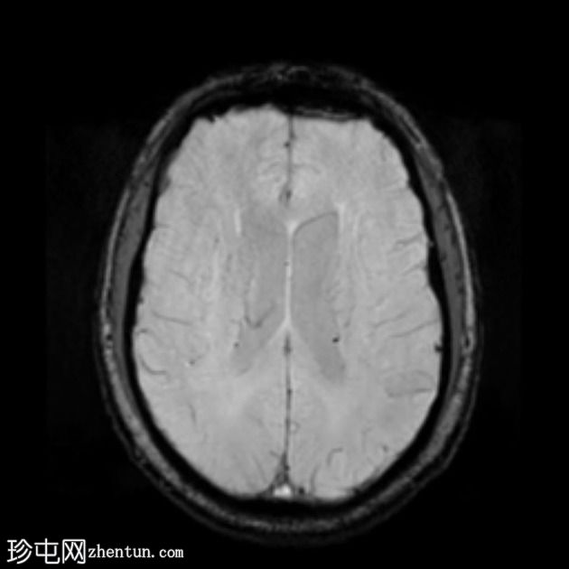 FTD-MND - 行为变异额颞叶痴呆