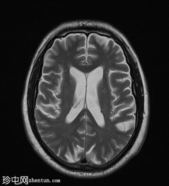 FTD-MND - 行为变异额颞叶痴呆