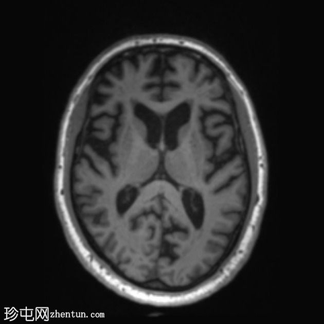 FTD-MND - 行为变异额颞叶痴呆