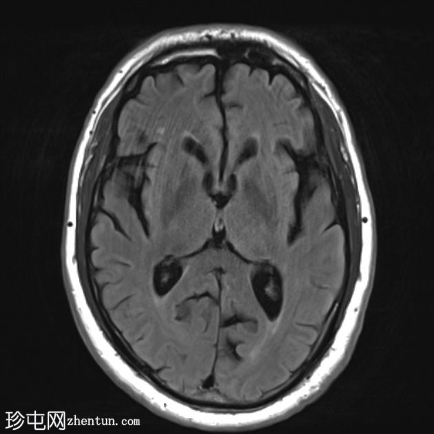 FTD-MND - 行为变异额颞叶痴呆