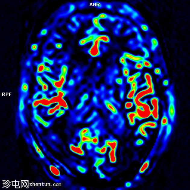 FTD-MND - 行为变异额颞叶痴呆