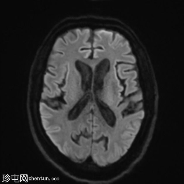 FTD-MND - 行为变异额颞叶痴呆